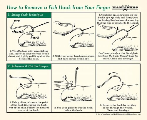 Illustration for article titled Remove a Fish Hook From Your Finger In Three Simple Steps